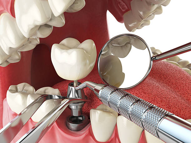 Best Emergency Wisdom Teeth Removal in Rlsbad, CA